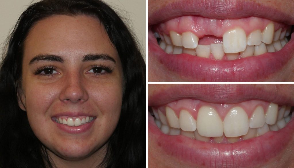dental implants from our dentist in Kalispell - before and after