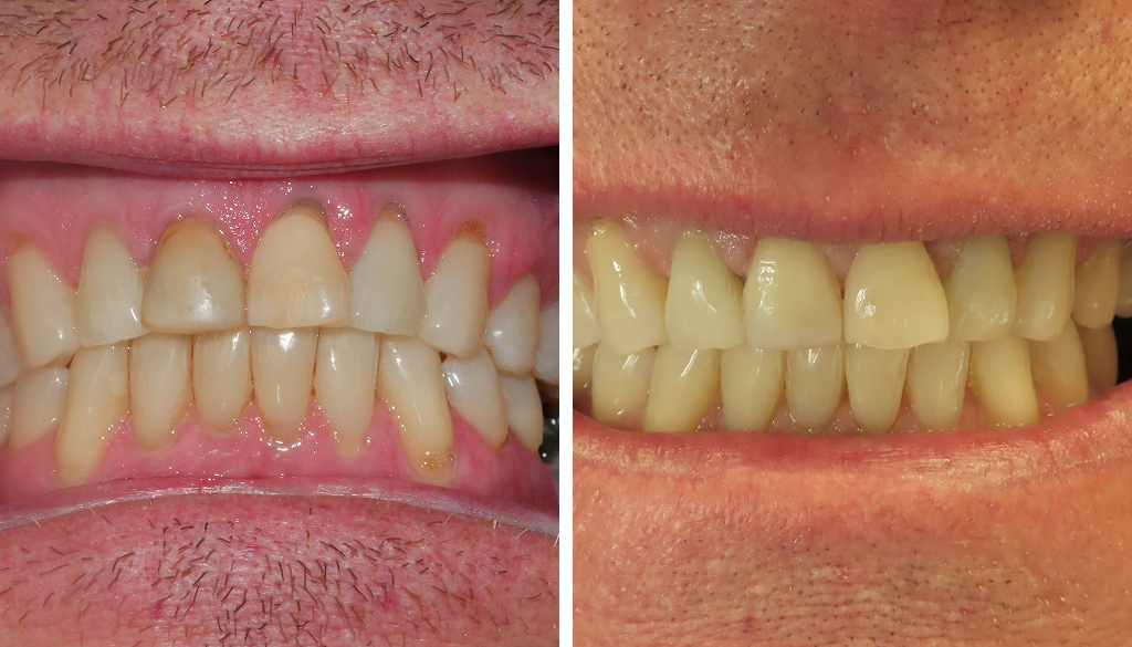 Whitening on a previously root-canaled tooth, followed by composite bonding